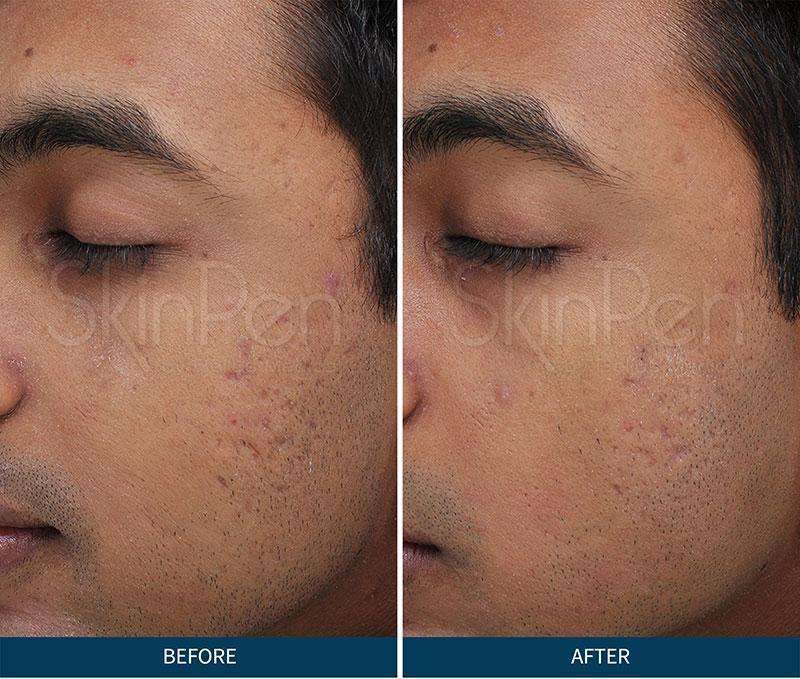Microneedling Before & After Pictures SkinPen Skin2O Spa www.skin2ospa.com