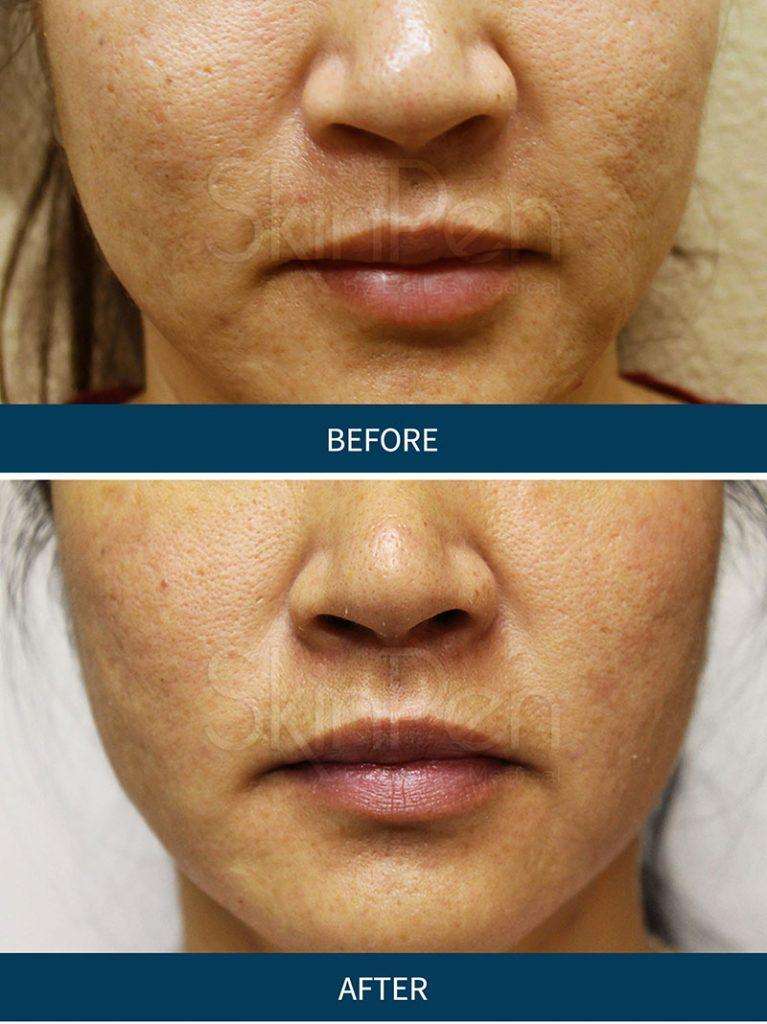 before after