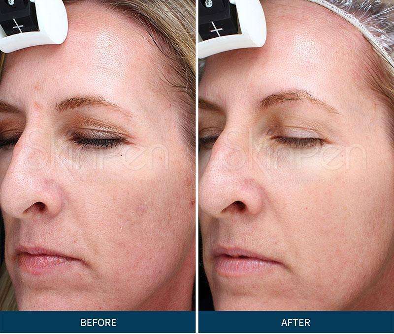 Microneedling Before & After Pictures SkinPen Skin2O Spa www.skin2ospa.com