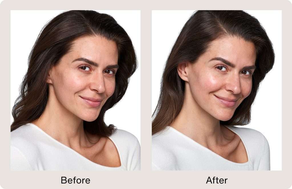 SkinVIVE Before and After