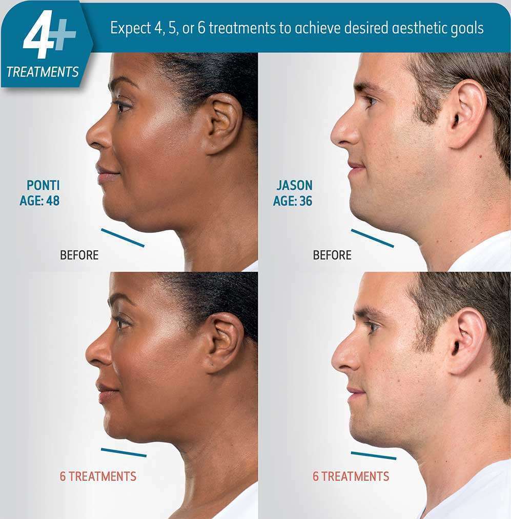 Kybella 4+ Before & After